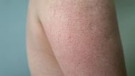 Keratosis pilaris (Image via Getty Images)